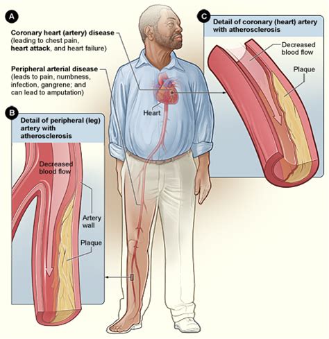 which statement best defines atherosclerosis